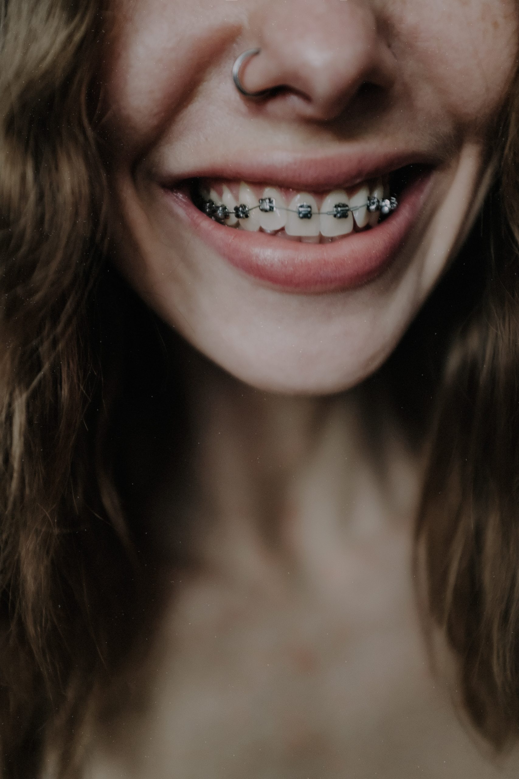 How Braces Can Improve Your Smile and Boost Your Confidence
