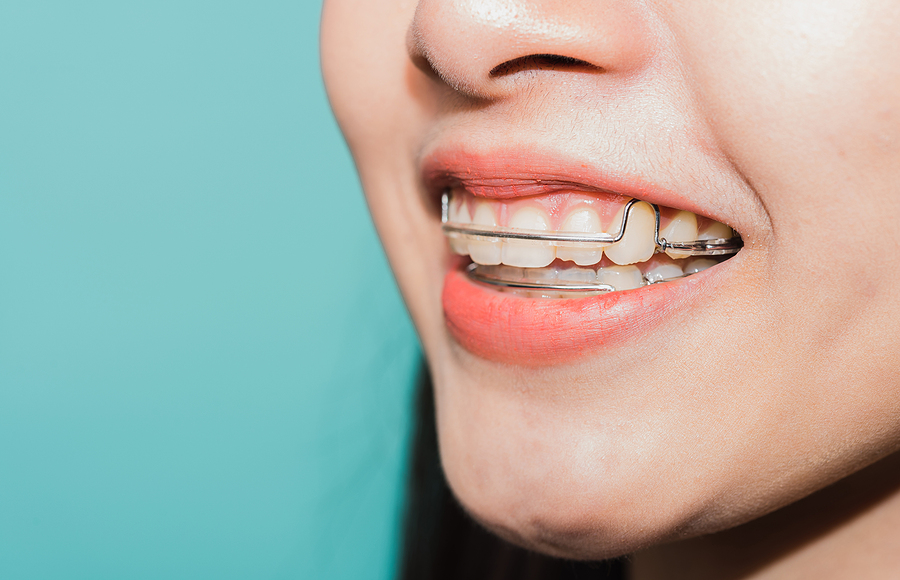Maintaining Your Smile: The Importance of Retainers in Argyle, TX