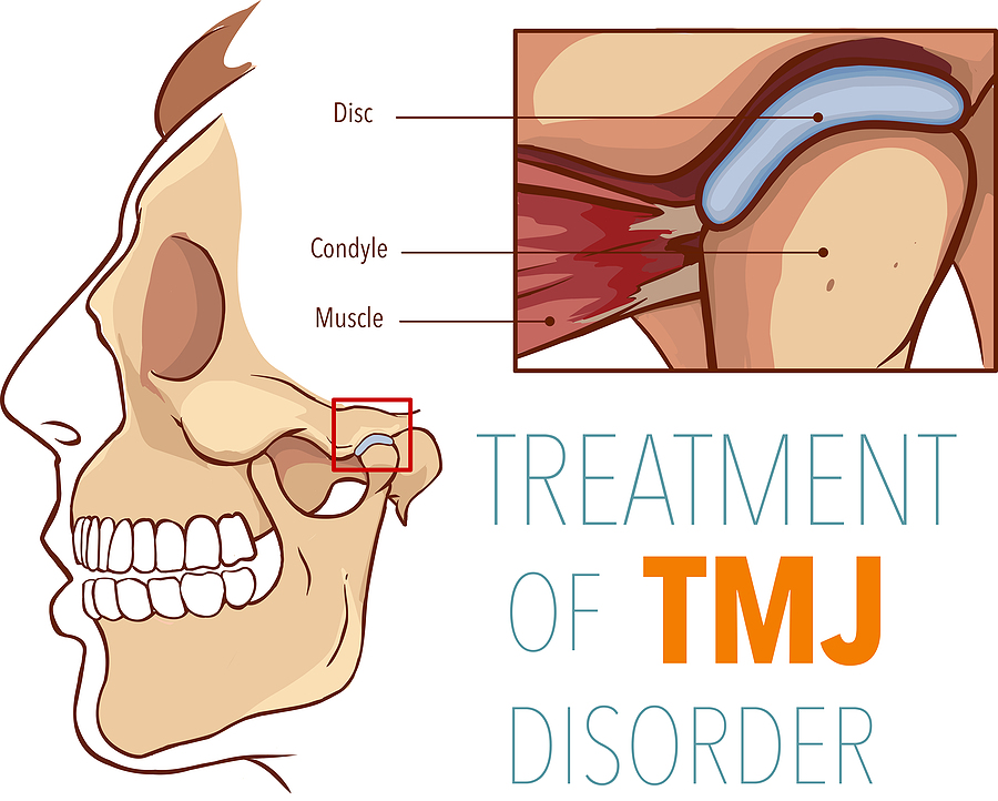 Relieving Jaw Pain: Comprehensive TMJ Treatment in Argyle, TX