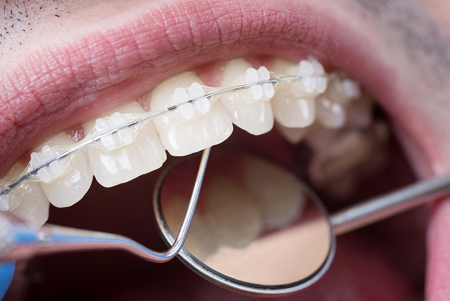 A Comprehensive Guide to the Different Types of Braces for a Perfect Smile